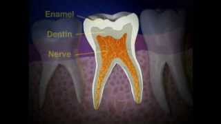 Pulpectomy to Save Nerve Damaged Tooth  Lake Merritt Dental Oakland CA [upl. by Aropizt584]