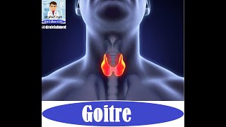 Goitre Thyroid Gland DiseasesCase Presentation  Medical Case Study Case Discussion Case Report [upl. by Sarena]