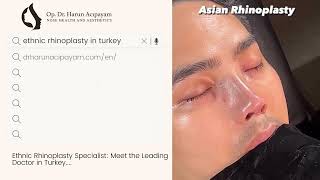 Asian Rhinoplasty Before and After  DrHarun Acıpayam [upl. by Huey27]