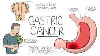 Gastric Cancer  An Overview for Students and Junior Doctors Including Troisiers Sign [upl. by Ellertnom]