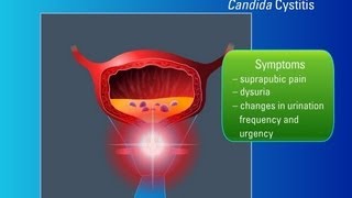 Candiduria Risk Factors Symptoms and Treatment [upl. by Kared]