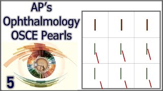 APs Ophthalmology OSCE Pearls 5 [upl. by Keener]