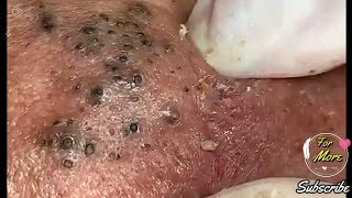 Dr Pop  Deep Blackheads in old Skin removing amp treatment 2020 Part 6 [upl. by Barbuto]