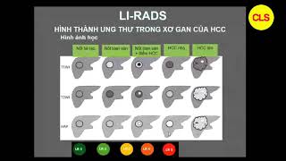 LIRADS  THS BS CKI NGUYỄN CÔNG QUỲNH [upl. by Fenton]