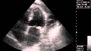 echocardiography pericardial effusionavi [upl. by Gelasius7]