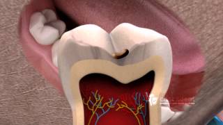 What is a Tooth Fissure [upl. by Andert183]