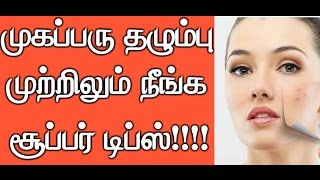 How to Remove Pimple Marks Naturally at Home in Tamil  Video  Beauty Tips in Tamil [upl. by Cheatham381]