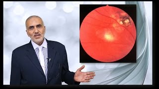 Elbromboly Basic ophthalmology IC Uvea Choroditis [upl. by Ezechiel]