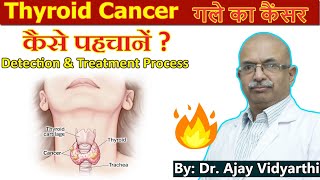 Thyroid Cancer Symptoms amp Treatment  गले का कैंसर  Process of Treatment  By Dr Ajay Vidyarthi [upl. by Paul]