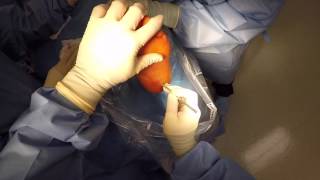 Plantar Fasciotomy [upl. by Aennil]