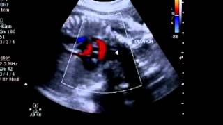 Both ductal and aortic arches fetal [upl. by Elwyn510]