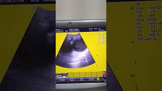 Lower abdomen scan  hematometrocolpos ultrasound usg cervix hematocolpos baby pregnancytest [upl. by Yrrah]