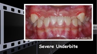 Severe Underbite Treatment [upl. by Bausch]