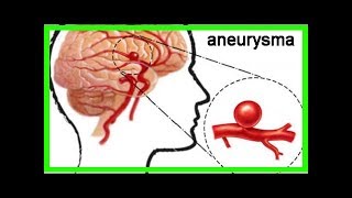 Aneurysma im Gehirn – Was ist das [upl. by Nad]