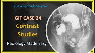 FRCR Radiology  A 58 yrs old patient presented with constipation  GIT Contrast Case 24 [upl. by Itagaki]