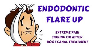 Endodontic Flare Up amp Management  Extreme pain amp swelling during amp after root canal treatmentRCT [upl. by Lotsirb129]