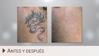 Eliminar tatuajes con láser  Antes y después [upl. by Beichner]