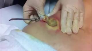 AMAZING CYST REMOVAL VERY SATISFYING [upl. by Nywde649]