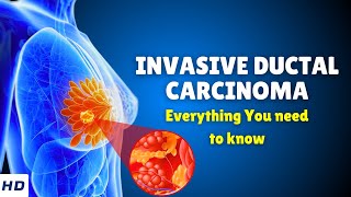 Invasive Ductal Carcinoma Breast Cancer – Causes Signs and Symptoms Diagnosis amp Treatment [upl. by Kathie370]