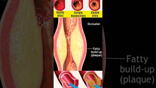 Atherosclerosis  shorts medical disease trending nursingking nursing mbbs [upl. by Fondea]