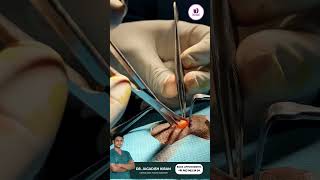 quotSebaceous Cyst Surgery Cost Recovery and Resultsquot  Sebaceous cyst treatment in Hyderabad [upl. by Sabanrab]