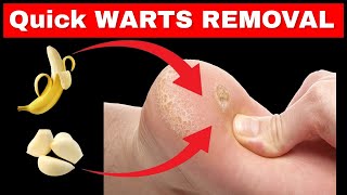 Wart Removal How to get rid of plantar warts PERMANENTLY at Home [upl. by Langill258]