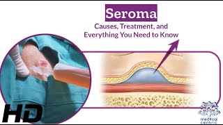 Seroma Breakdown Causes Treatment Options and Essential Tips [upl. by Dawaj]