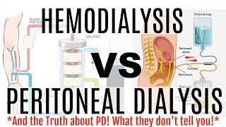 HEMODIALYSIS VS PERITONEAL DIALYSIS Which Dialysis is Best for You [upl. by Ahel]