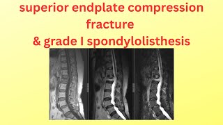 superior end plate compression fracture [upl. by Kermit]