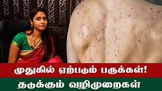 Proper Treatment For Back Acne  முதுகில் உள்ள பருக்களுக்கு நீங்கள் செய்யவேண்டியது செய்யக்கூடாதது [upl. by Nagap278]