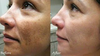 Azelaic acid cream for Acne  melasma  Pigmentation  Uneven skin  Dark spot  Brijwasi Girl [upl. by Ybloc]