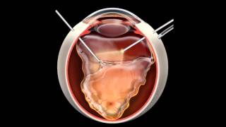 Retinal Detachment  Signs Symptoms and Treatment [upl. by Kuo]