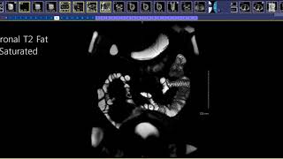 How to read an MR Enterography [upl. by Lerraj219]