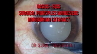 BasicsSICS in a Morgagnian Cataract [upl. by Acirem552]