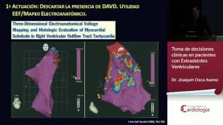 Toma de decisiones clínicas en pacientes con Extrasístoles Ventriculares [upl. by Attiuqahs738]