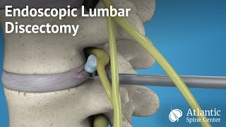 Endoscopic Lumbar Discectomy [upl. by Craner]