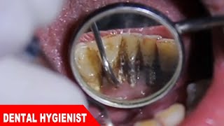 Deep Cleaning With HEAVY Tartar Build Up At The Dentist [upl. by Cl]