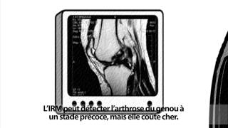 Larthrose est une maladie qui se soigne [upl. by Yolanda994]