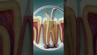 Root Canal Treatment  Curveia Dental I RCT [upl. by Ahtaga]