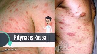 What is Pityriasis Rosea [upl. by Anaiq]