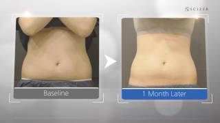 Scizer  Permanently eradicate fat cells MFSU Technology before amp after [upl. by Sudhir268]