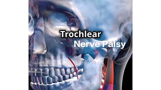 Trochlear Nerve Palsy  English [upl. by Heinrich908]