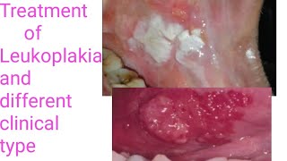 Treatment of LeukoplakiaTypes of Leukoplakia Different treatment modalities of Leukoplakia PVLVH [upl. by Sacksen303]