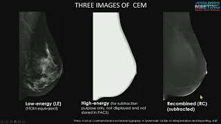 Contrast Enhanced Mammography  Course Sample [upl. by Ramoj200]