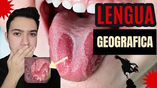 ¿Qué es la lengua geográfica  glositis migratoria benigna  Causas y tratamientos 👈😲 [upl. by Conrado]