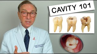 What Causes Tooth Decay Cavity 101  Causes  Treatment [upl. by Oaht]