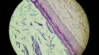 Cisto folicular infundibular [upl. by Averil]