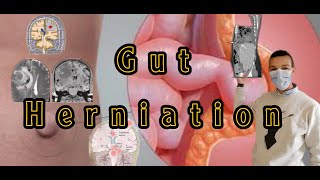 Physiological gut herniationimaging amp physiology فتق القناة الهضمية pathology الأشعة [upl. by Herbie]