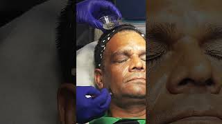 chemical peel for hyperpigmentation and skin rejuvenation at bhaskar cosmoclinic uttam nagar nd59 [upl. by Ikciv414]