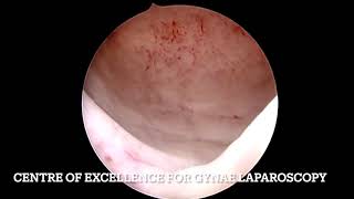 CERVICAL ECTOPIC PREGNANCY HYSTEROSCOPIC MANAGEMENT [upl. by Akirej758]